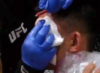 慢镜头回放宋亚东遭重创瞬间！伤口触目惊心，对手获胜跪地不敢信