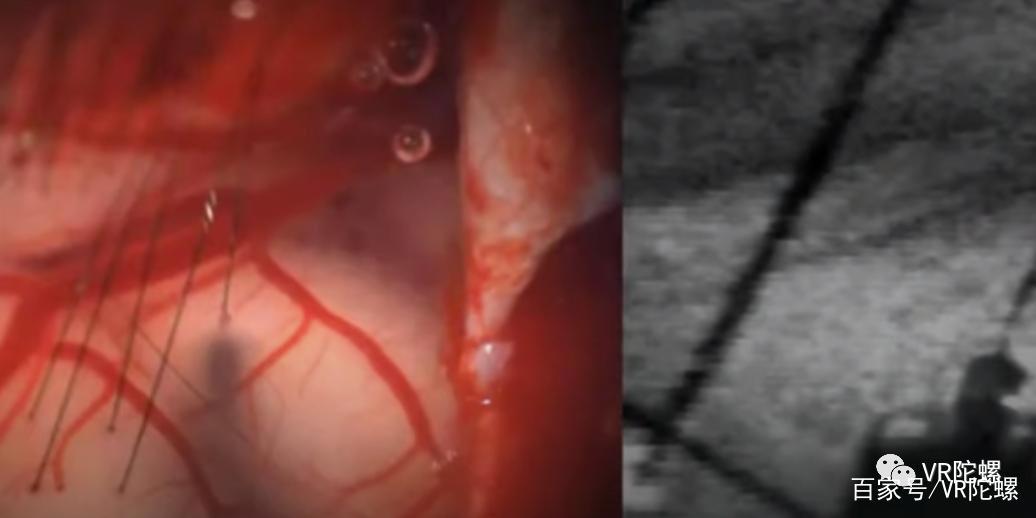 马斯克脑机设备获批人脑试验，“数字永生”时代真的要来了吗？