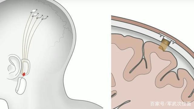 吊打上司，独占女神，马斯克说一年就将植入人脑的脑机接口有多神